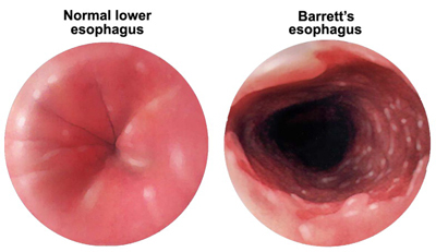 Normal Esophagus Compared To Barretts Esophagus