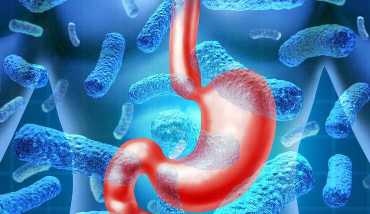 Atypical Gerd Chronic Cough