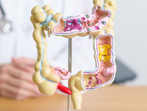 Refractory Constipation