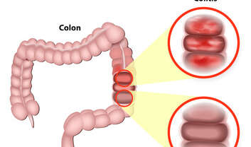 Ulcerative Colitis