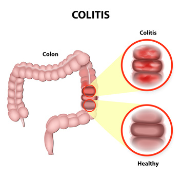 Ulcerative Colitis